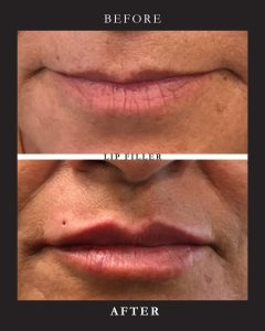 the-fix-brow-lift-before-after-01.webp.jpg