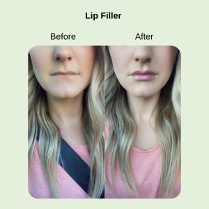 the-fix-helix-fusion-skin-resurfacing-before-after-01.webp.jpg