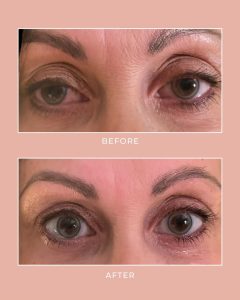 the-fix-lip-filler-before-after-01.webp.jpg