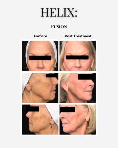 the-fix-lip-filler-before-after-02.webp.jpg