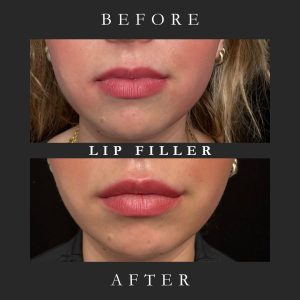 the-fix-lip-filler-before-after-03.webp.jpg